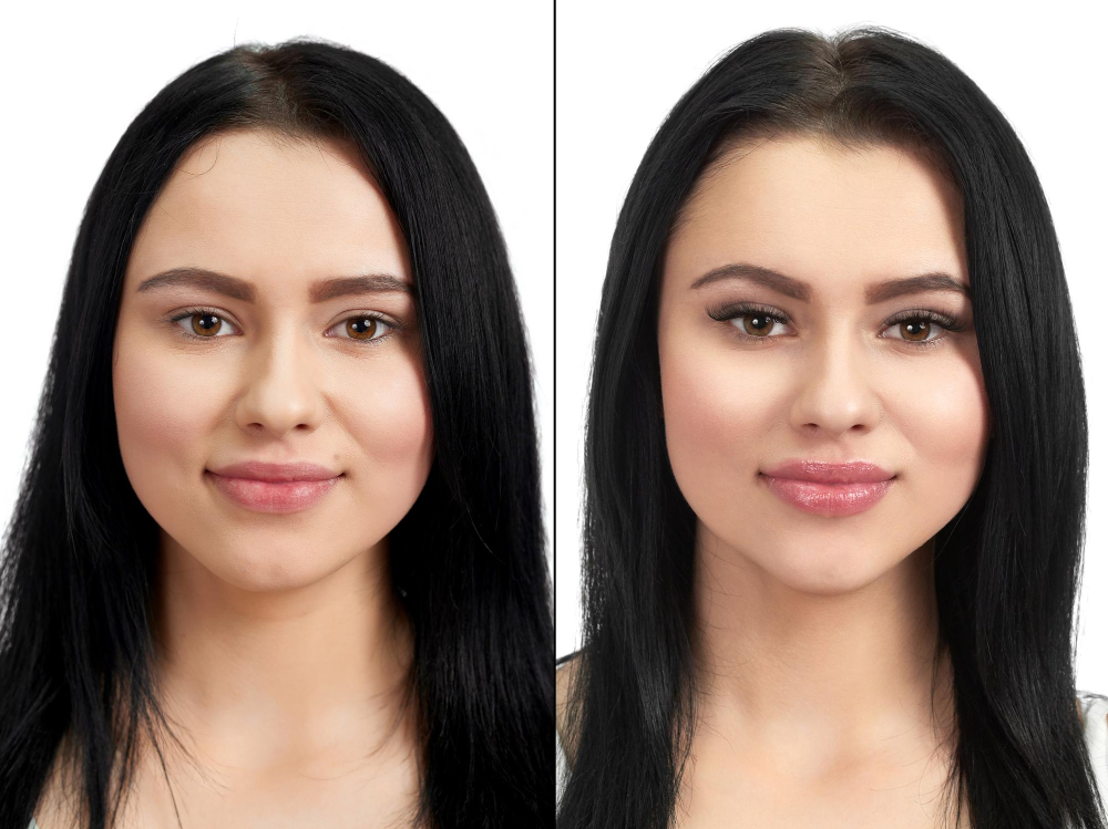 Queiloplastia